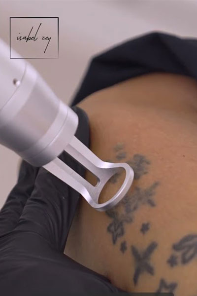 Tattooentfernung-Anwendung