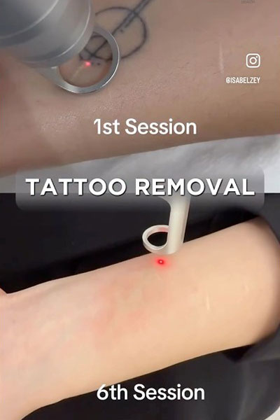 Tattoo Removal Application