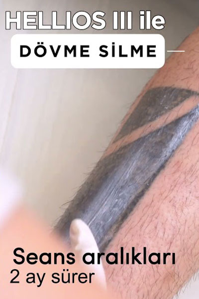 Dövme Silme İşlemi